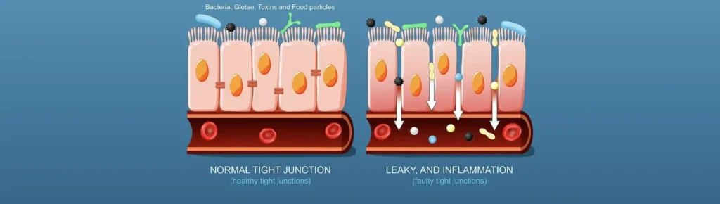 Leaky Gut Syndrom – Wenn die Darmbarriere ihre Schutzfunktion verliert